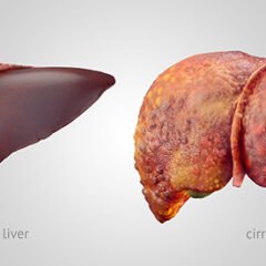 Your Liver is Silent… Until It’s Too Late