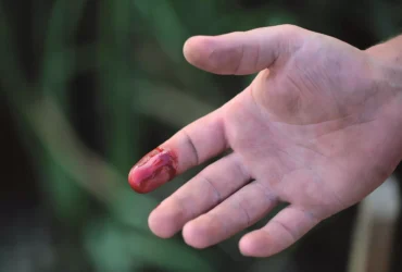 bleeding-finger-haemophilia-b-scaled